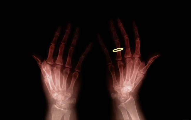 Обои картинки фото разное, кости,  рентген, руки, кольцо